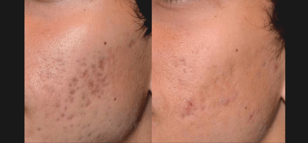 PicoSure Skin Before &amp; After 1