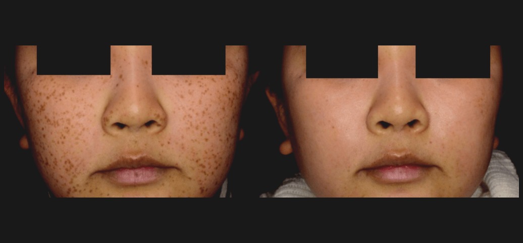 PicoSure Skin Before &amp; After 2