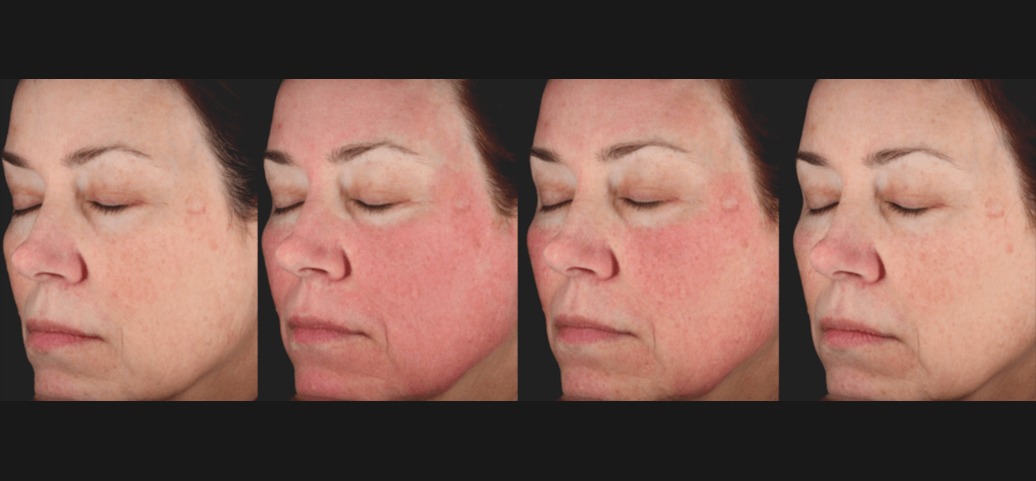 PicoSure Skin Before &amp; After 3