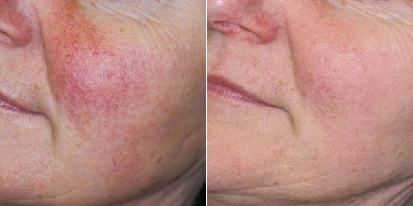 Rosacea Before & After