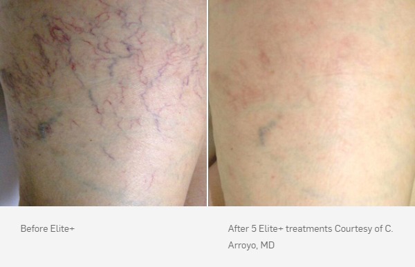 Laser Vein Removal Before and After, 5 Elite+ treatments