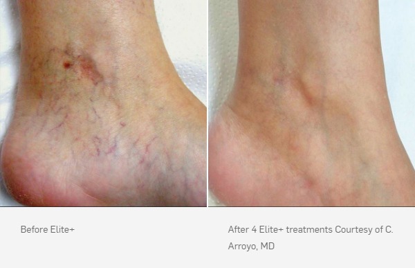 Laser Vein Removal Before and After, 4 Elite+ treatments
