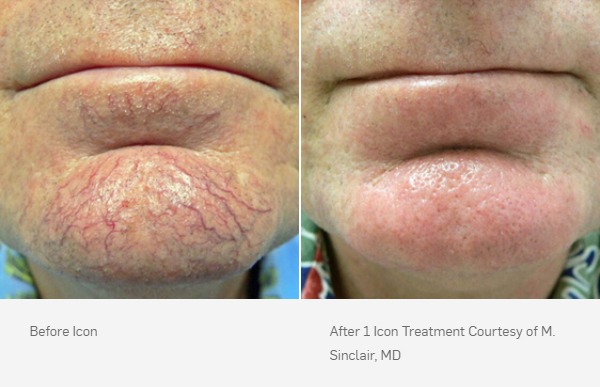 Laser Vein Removal Before and After, 1 ICON treatment
